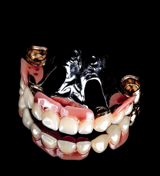 R&V Qualitätszahntechnik - Dentallabor - ein gegossenes Metallgerüst für eine herausnehmbare Teilprothese,